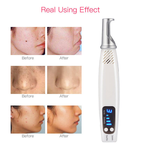 Handheld Laser Heat Picosecond Pen Scar Mole Freckle Dark Spot Removal